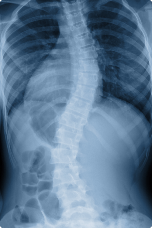 Living with Scoliosis: A Chiropractic Perspective